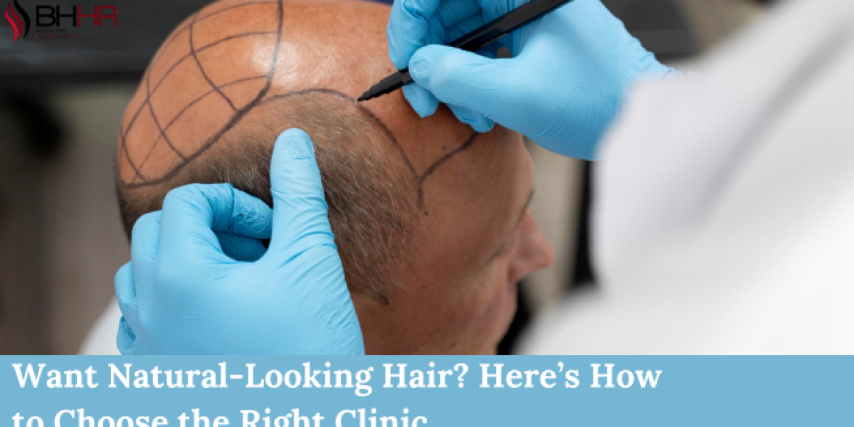 Want Natural-Looking Hair? Here’s How to Choose the Right Clinic