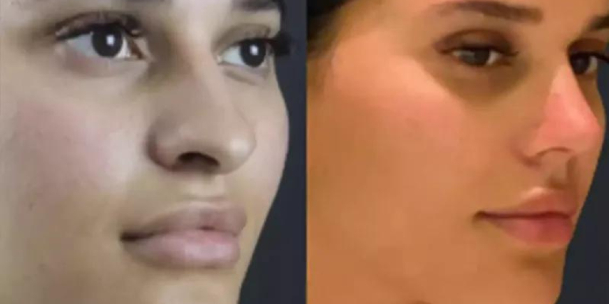 How Rhinoplasty in Dubai Enhances Facial Harmony