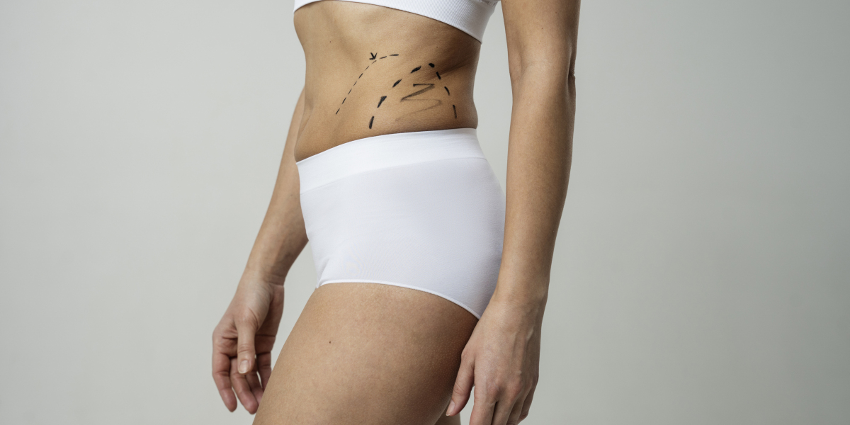 Liposuction Considerations Guidance from Best Liposuction Surgeons in Dubai