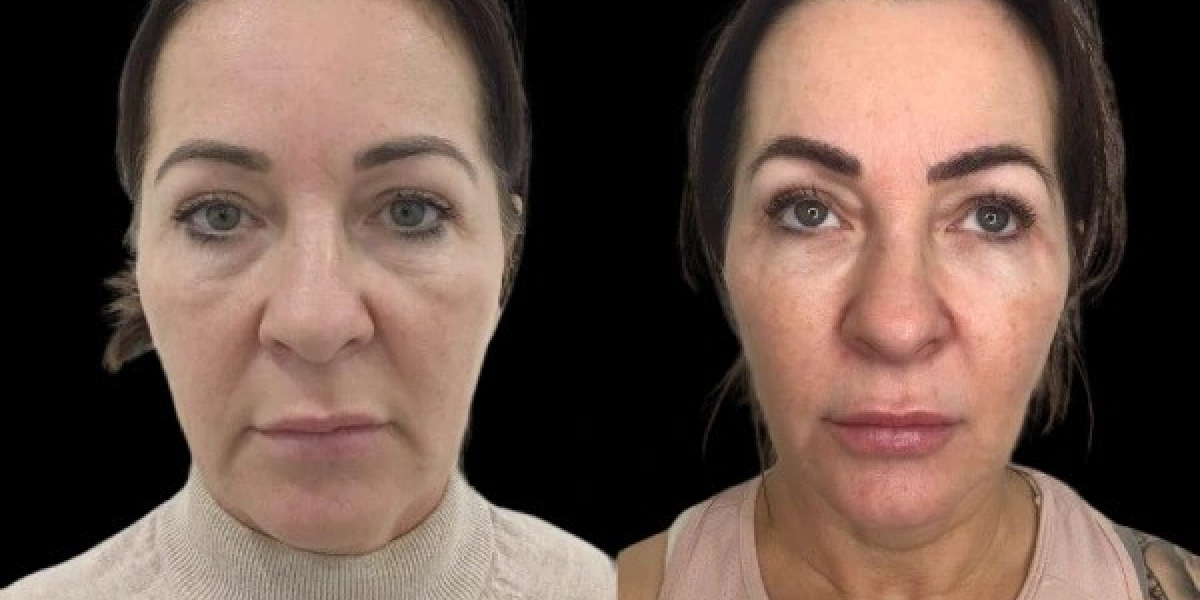 Personalized Profhilo Plans from the Best Plastic Surgeons in Dubai