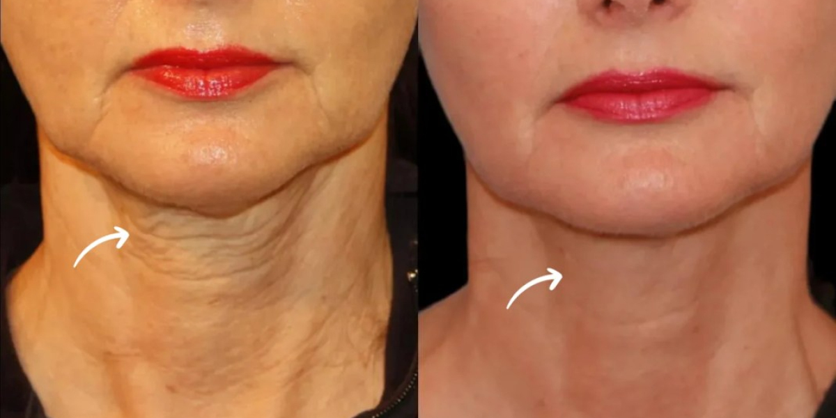 Reverse Sagging with Sculptra Fillers Treatments in Dubai