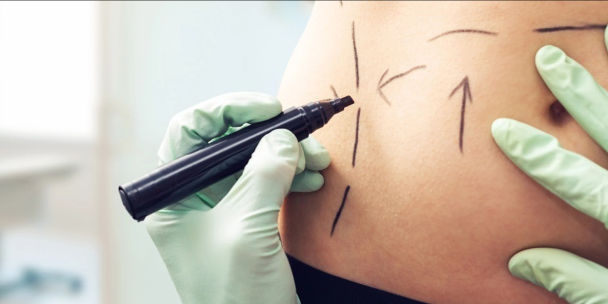 Truth About Liposuction Straight from Best Liposuction Surgeon in Dubai