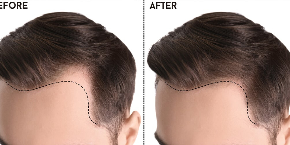 Restoring Confidence: A Comprehensive Guide to Hair Transplants in Pakistan