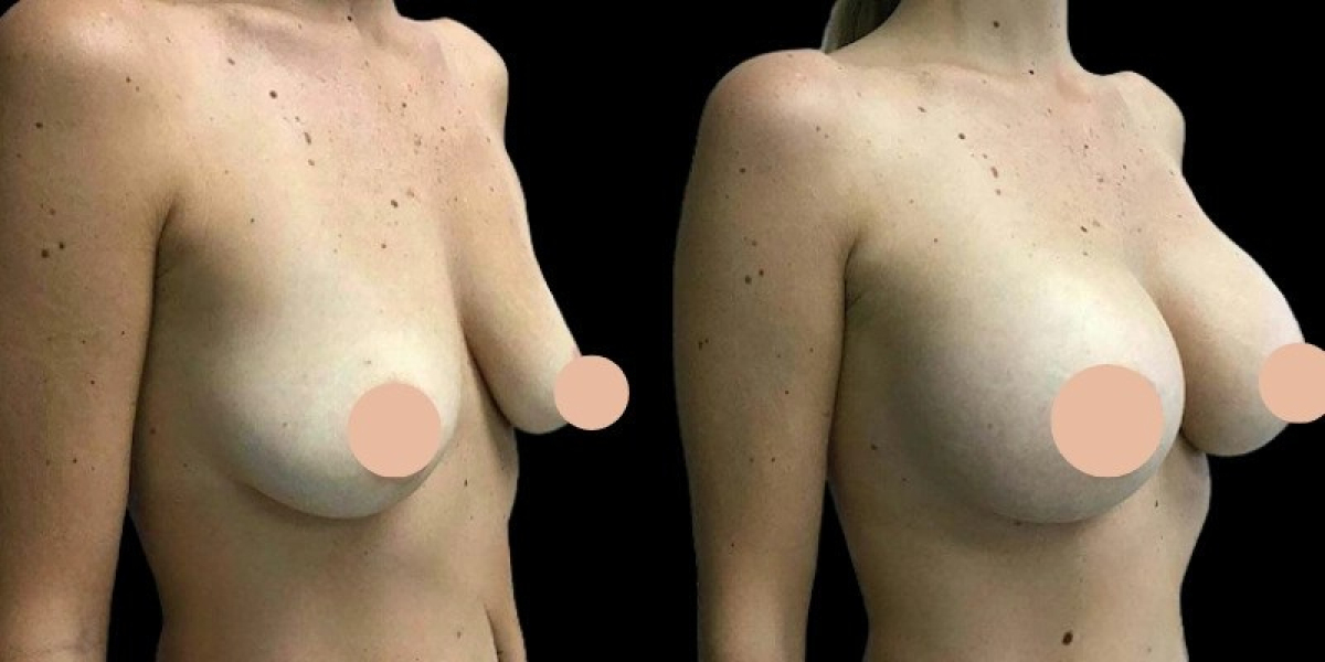 Breast Augmentation in Dubai What to Know Before Your Consultation