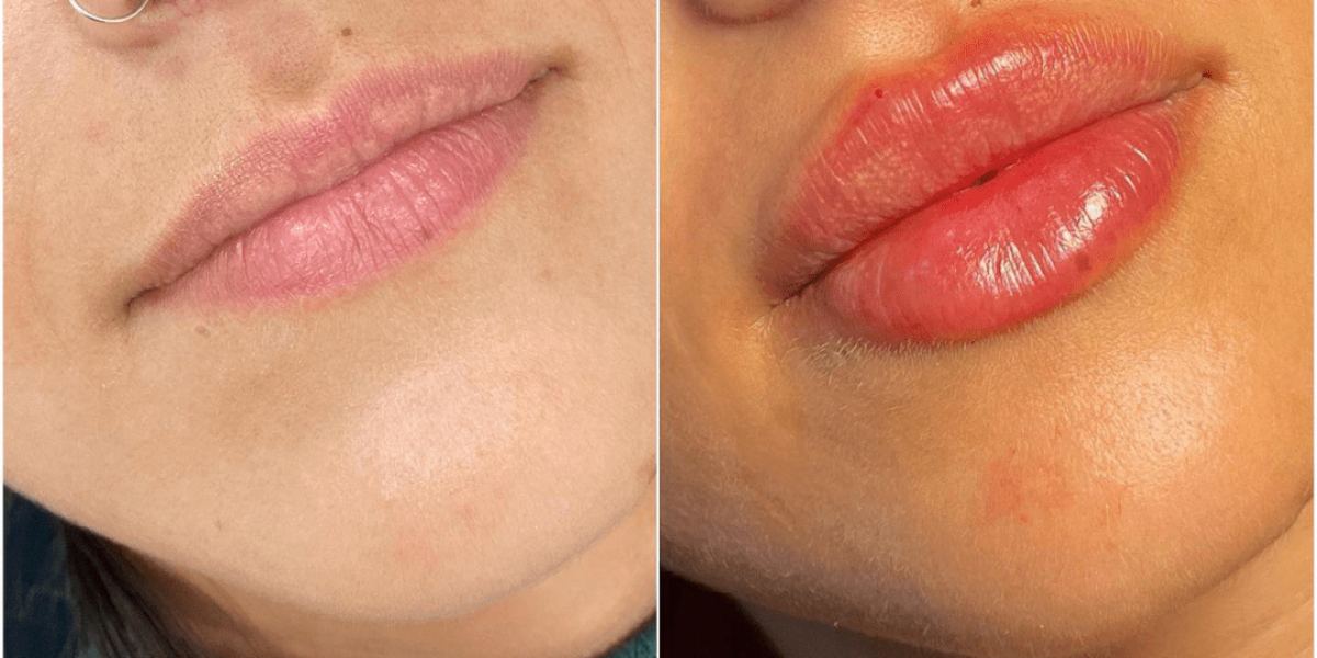 Juvederm Treatment in Dubai for Younger-Looking Eyes