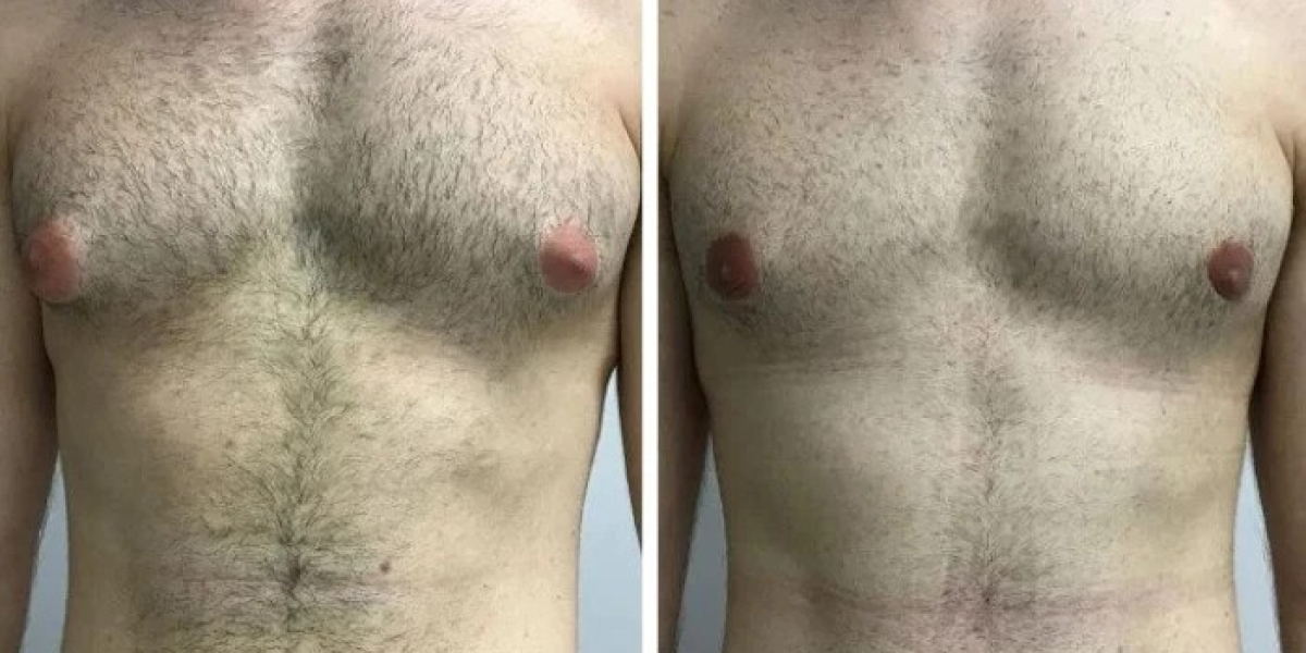 Success Rate of the Best Gynecomastia Surgeon in Dubai: What the Data Says