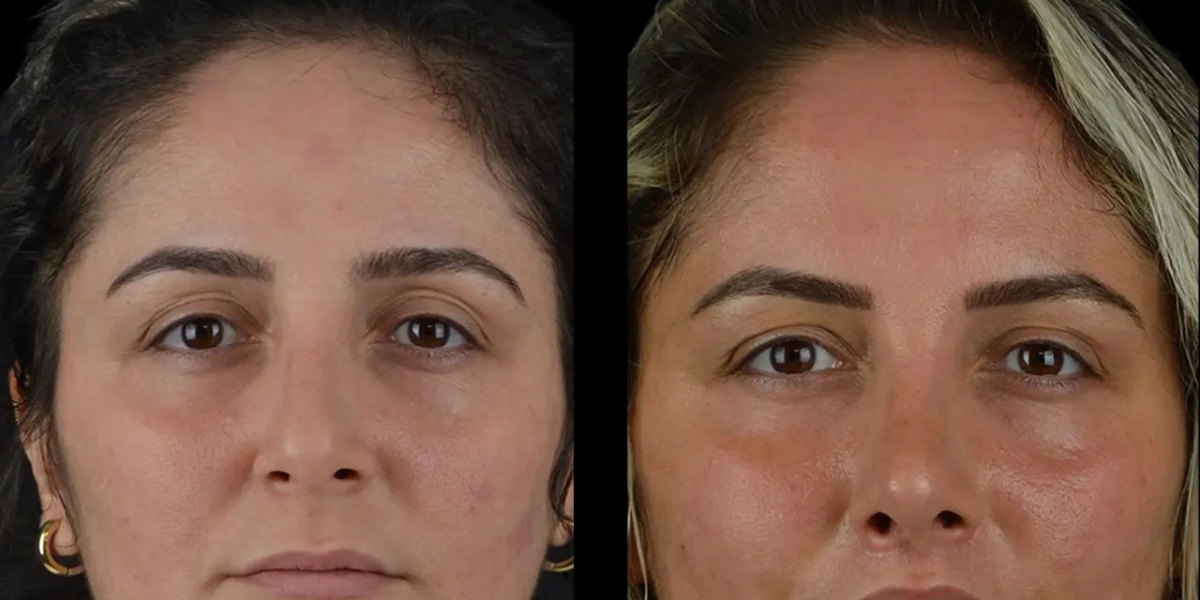 Are Cheek Fillers in Dubai Safe? Expert Insights