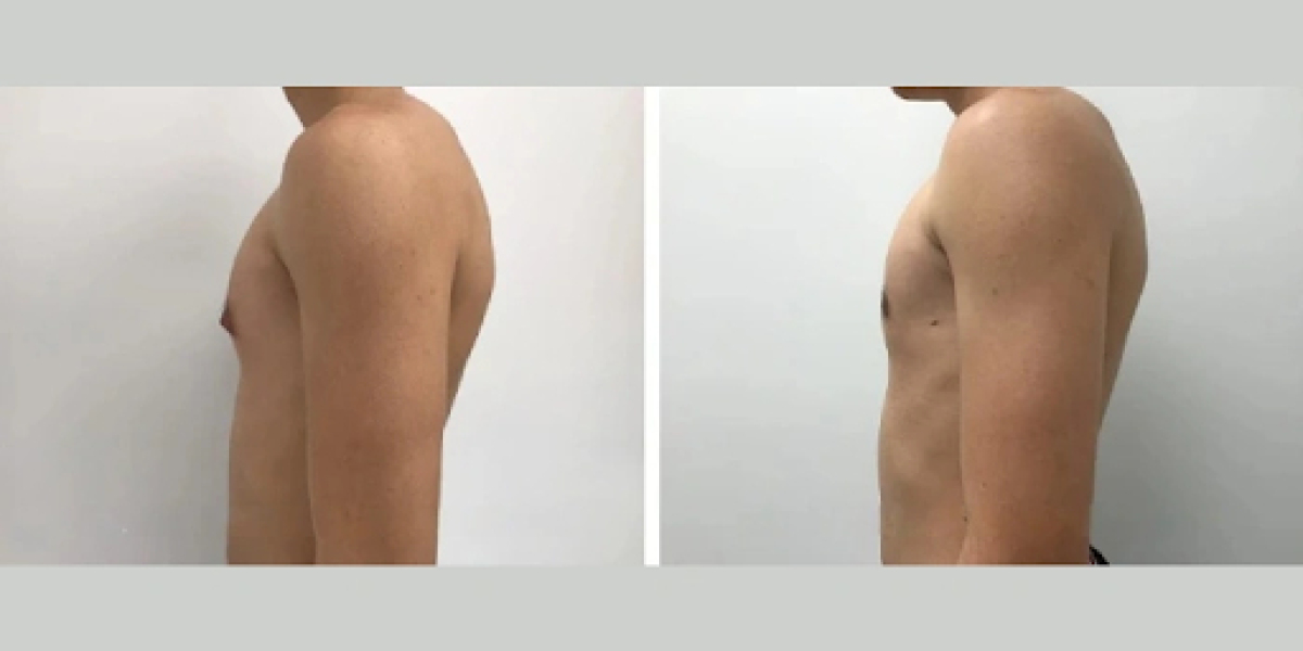 Dealing with Gynecomastia in Your 20s: Dubai Solutions for a Confident Future