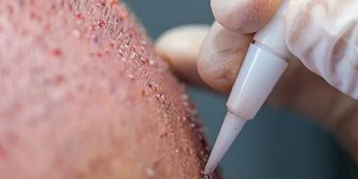Where to get the best and most affordable hair transplant?