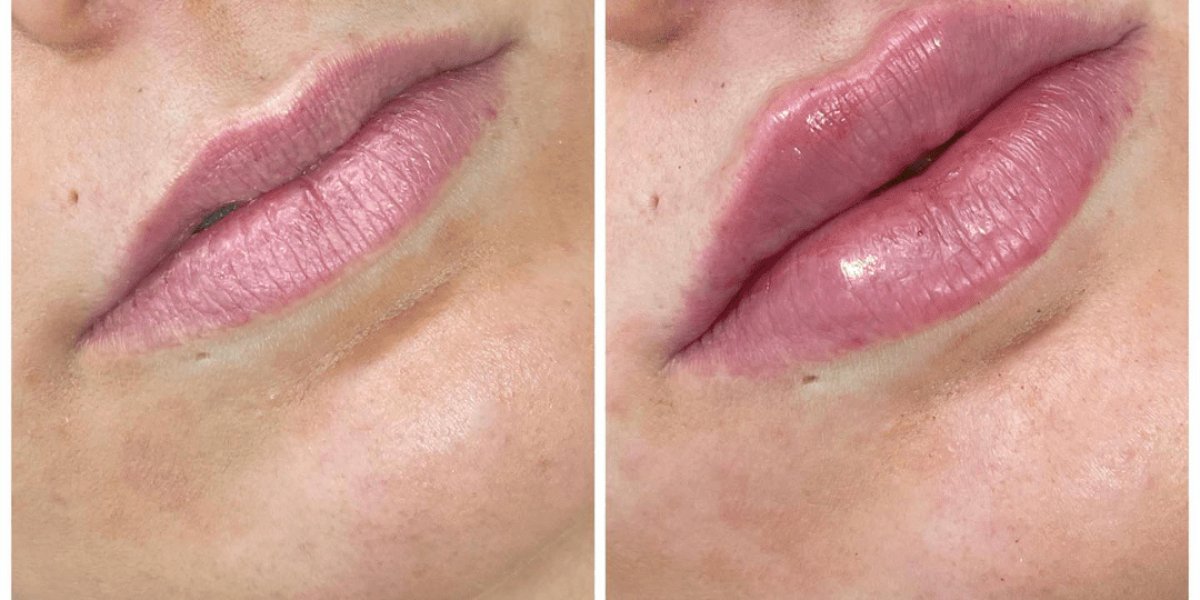 The Role of Technology in Dermal Fillers Treatment in Dubai