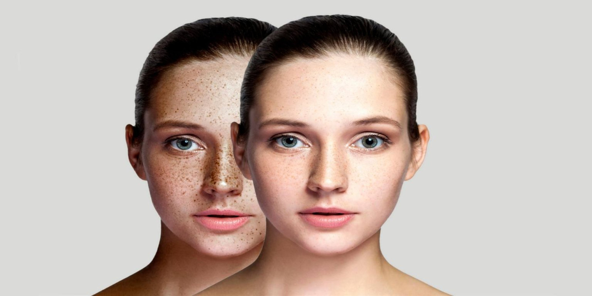EMTONE Treatment in Clermont, FL for Smooth Skin