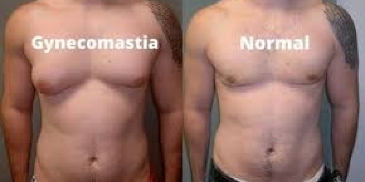 How Male Breast Reduction in Islamabad Can Change Your Life