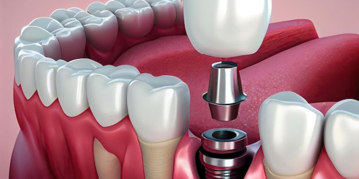 A Complete Guide to Dental Implants: A Reliable Solution for Missing Teeth