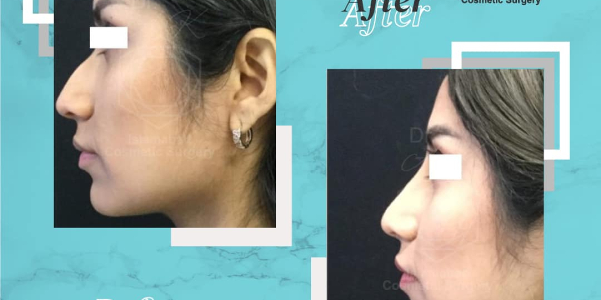 Benefits of Consulting a Skilled Rhinoplasty Surgeon in Islamabad
