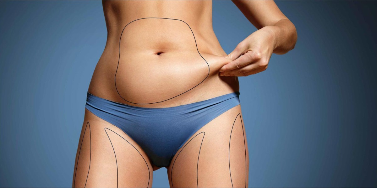 Abdominoplasty in Dubai: Removing Excess Skin
