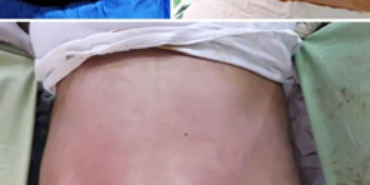 How to Find Affordable Liposuction Cost in Pakistan Without Compromising Quality