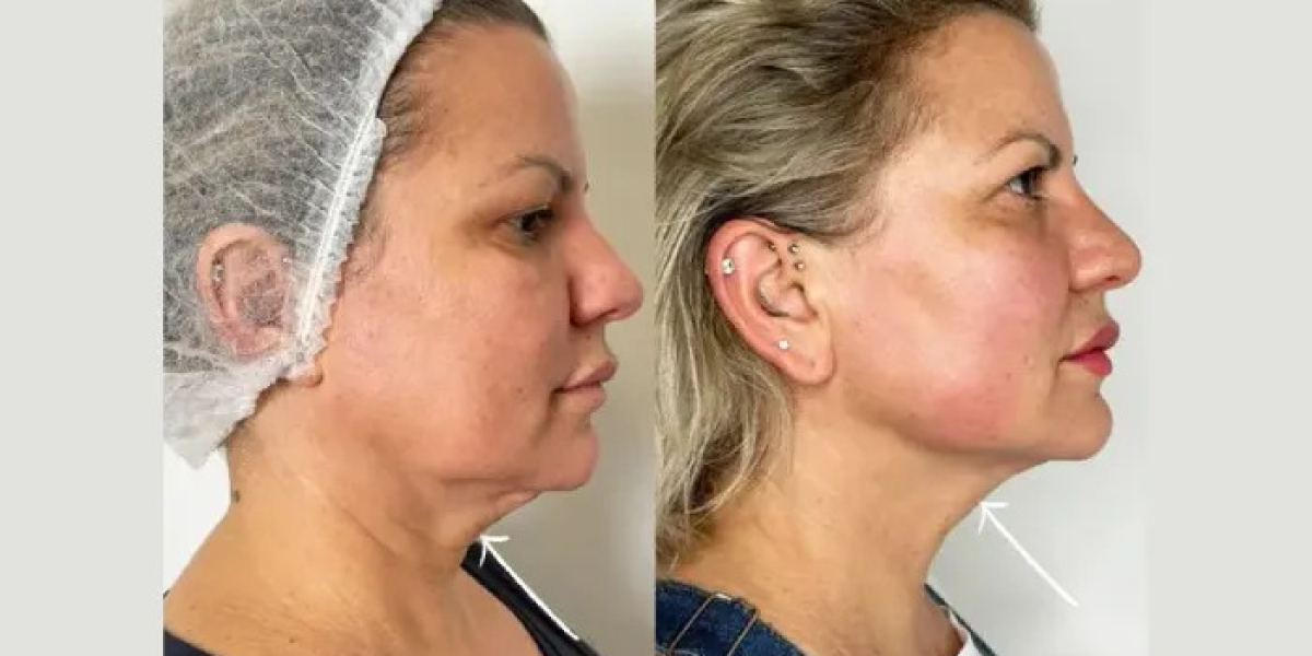 Why the Best Aesthetic Clinic in Dubai Is My Go-To for Endolift Treatments