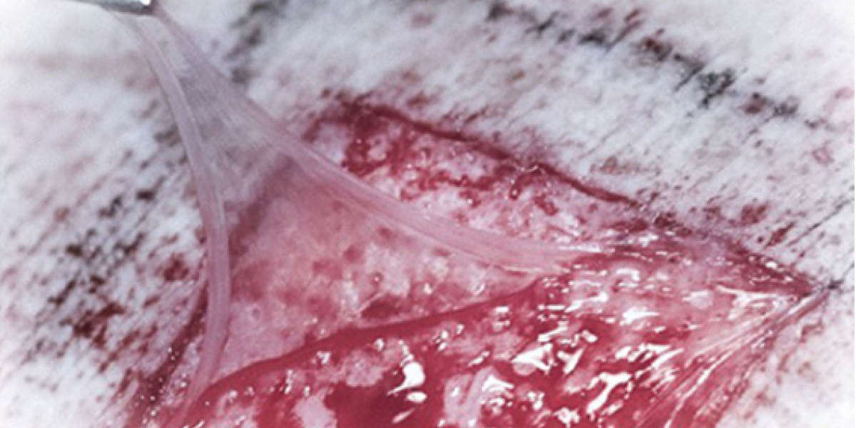 Healing Innovation with Helicoll Graft Solutions