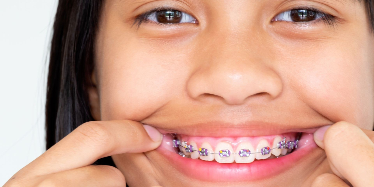 Ortodoncia Invisible en Barcelona Sonrisa Perfecta sin Brackets