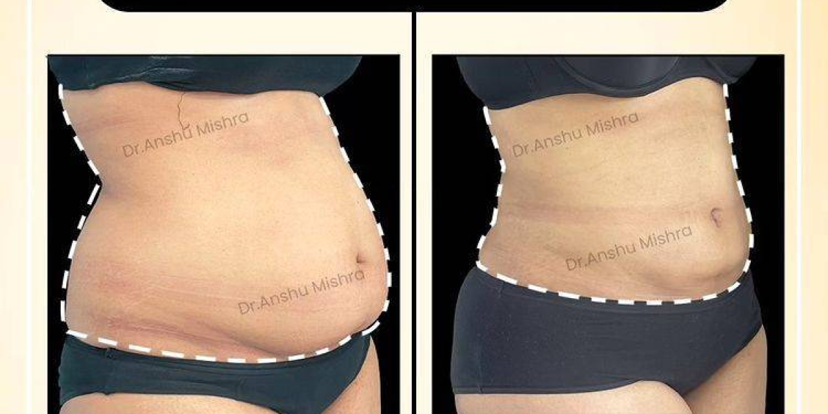 Liposuction Cost in Dubai | Liposuction Surgery in Dubai by Dr. Hans
