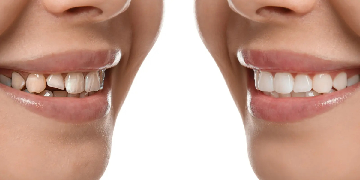 Affordable Options for Smile Makeover in Mumbai