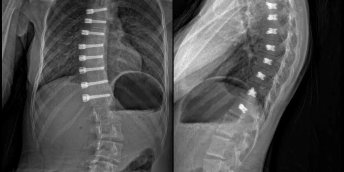 Pediatric Scoliosis Specialist Florida