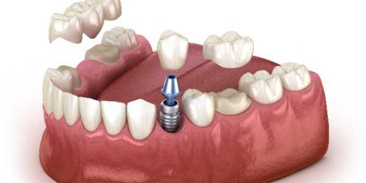 The Pros and Cons of Mini Dental Implants for Limited Bone Cases