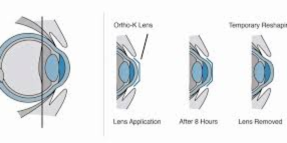 Orthokeratology Malaysia: Safe and Effective Vision Correction