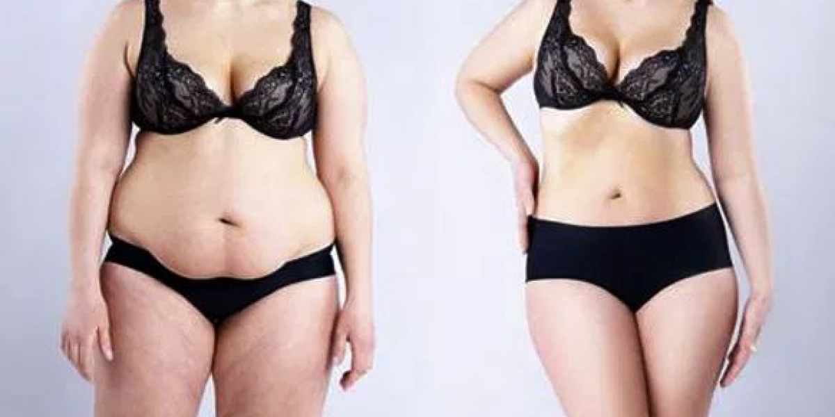 Transform Your Confidence with a Tummy Tuck in Bangalore at Aesthetic International