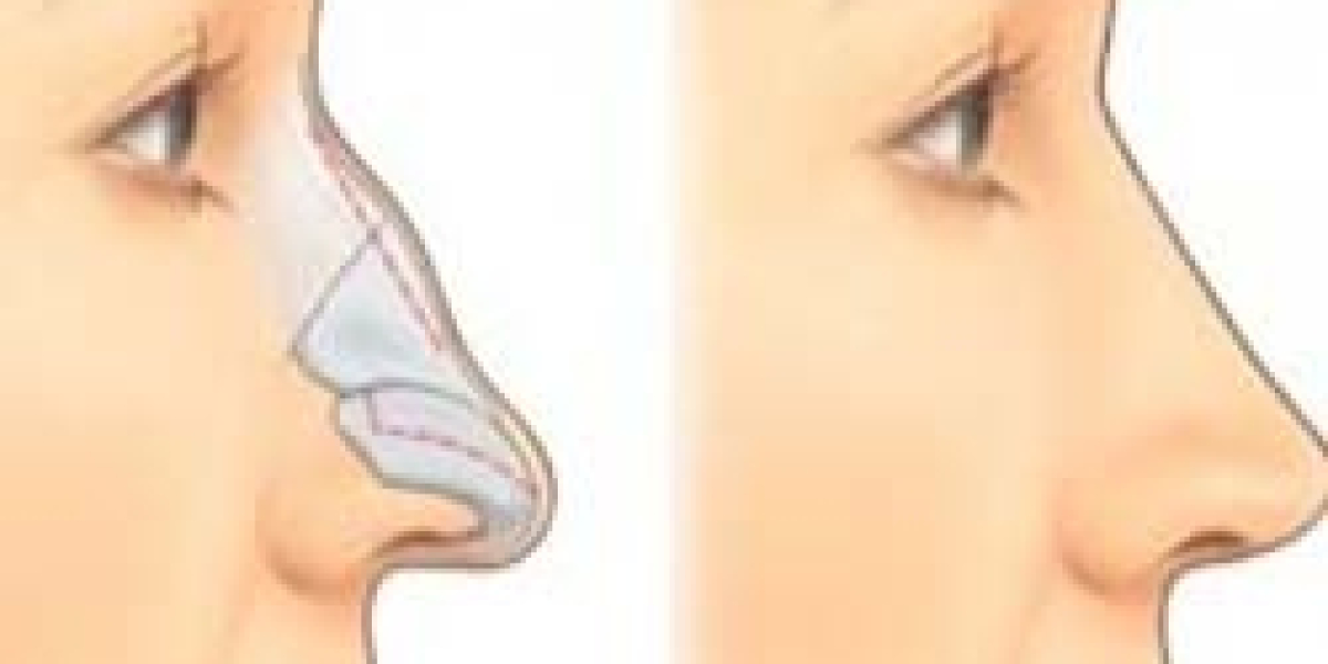 Nose Surgery in Islamabad: Enhancing Appearance and Breathing with Expertise