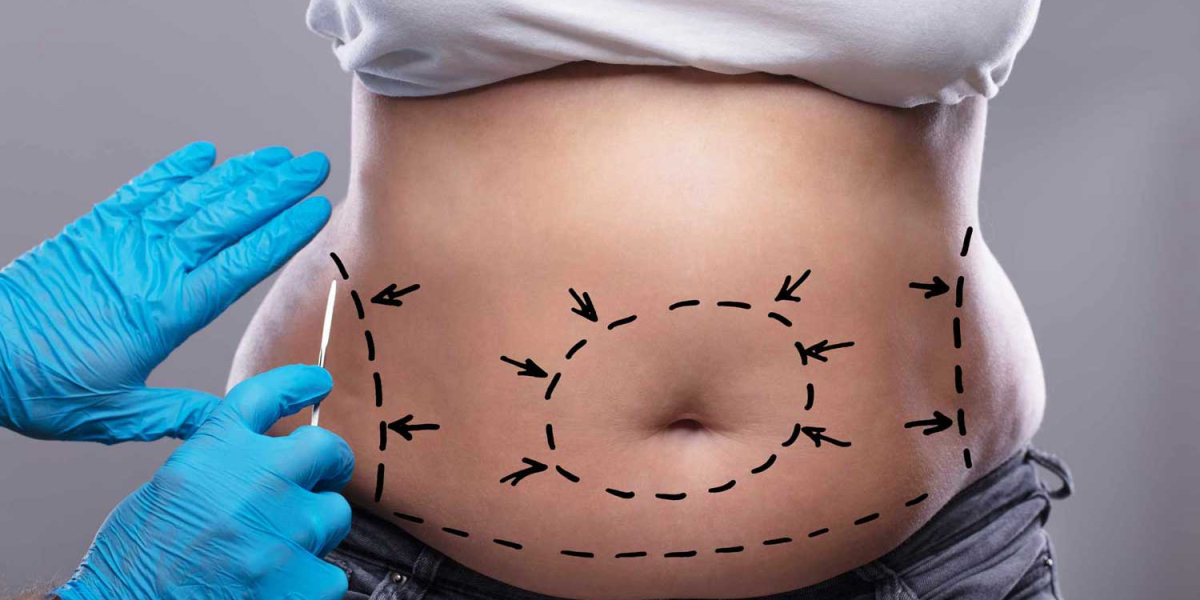 Combining Tummy Tuck with Other Cosmetic Surgeries in Dubai