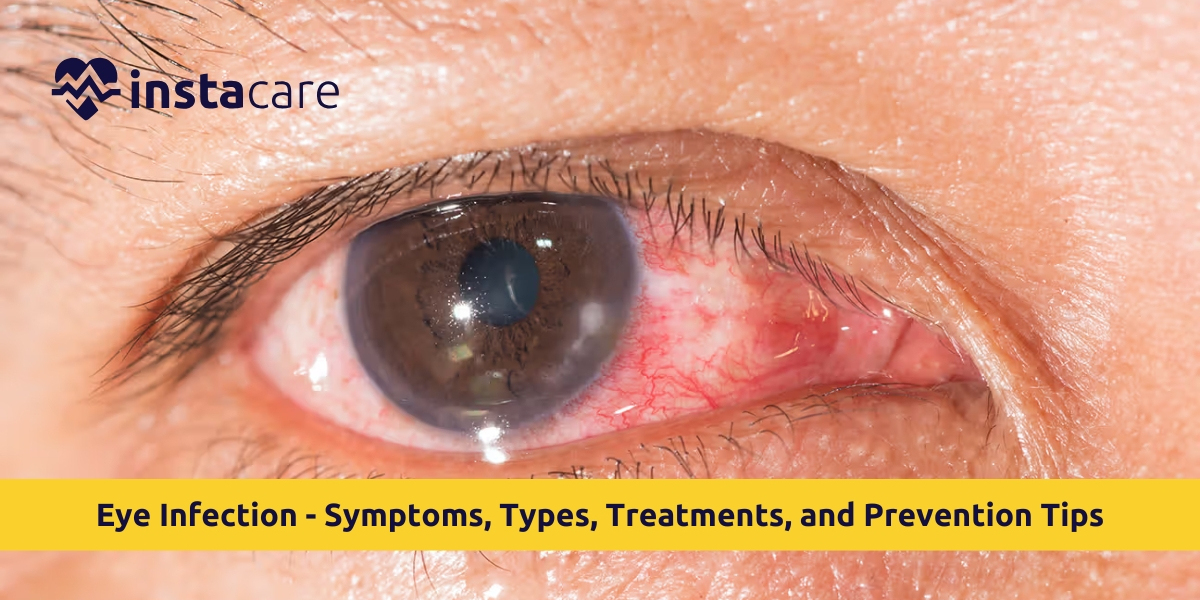 Eye Infection: Symptoms, Causes & Treatment