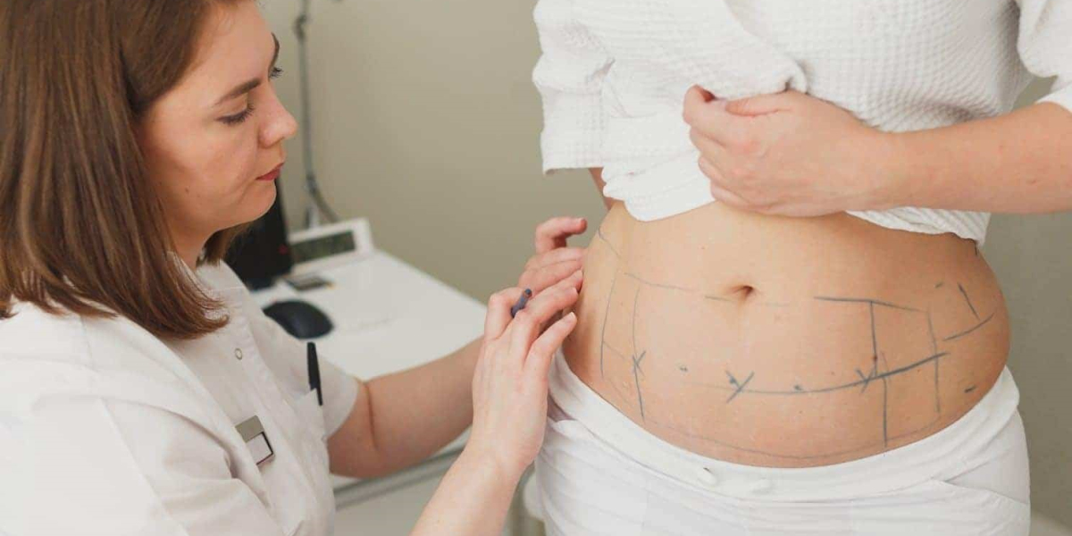 How Liposuction Procedure Sculpts Specific Areas