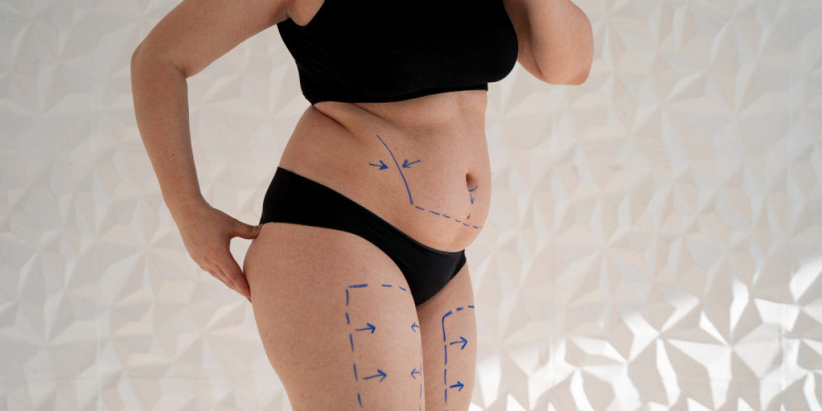 Can Liposuction Treat Cellulite? Here’s the Truth