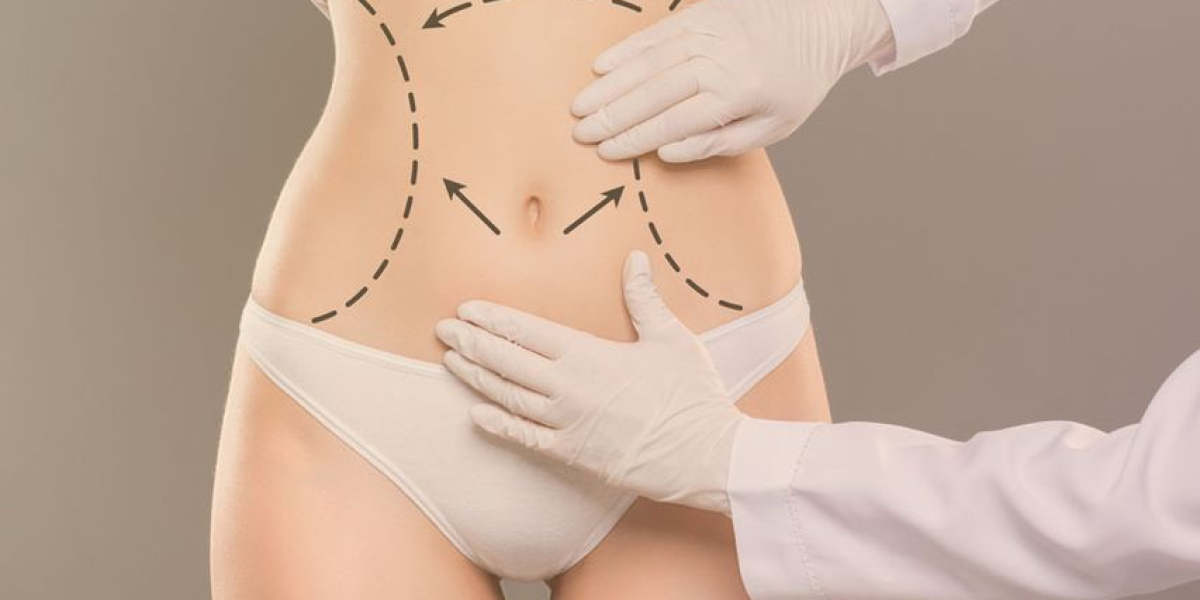 Understanding Abdominoplasty Dubai: What the Procedure Involves