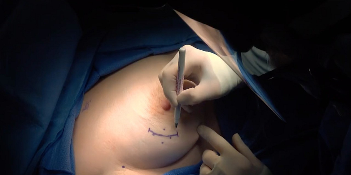 Lumpectomy Surgery in India Explained – Benefits, Procedure, and Recovery Timeline