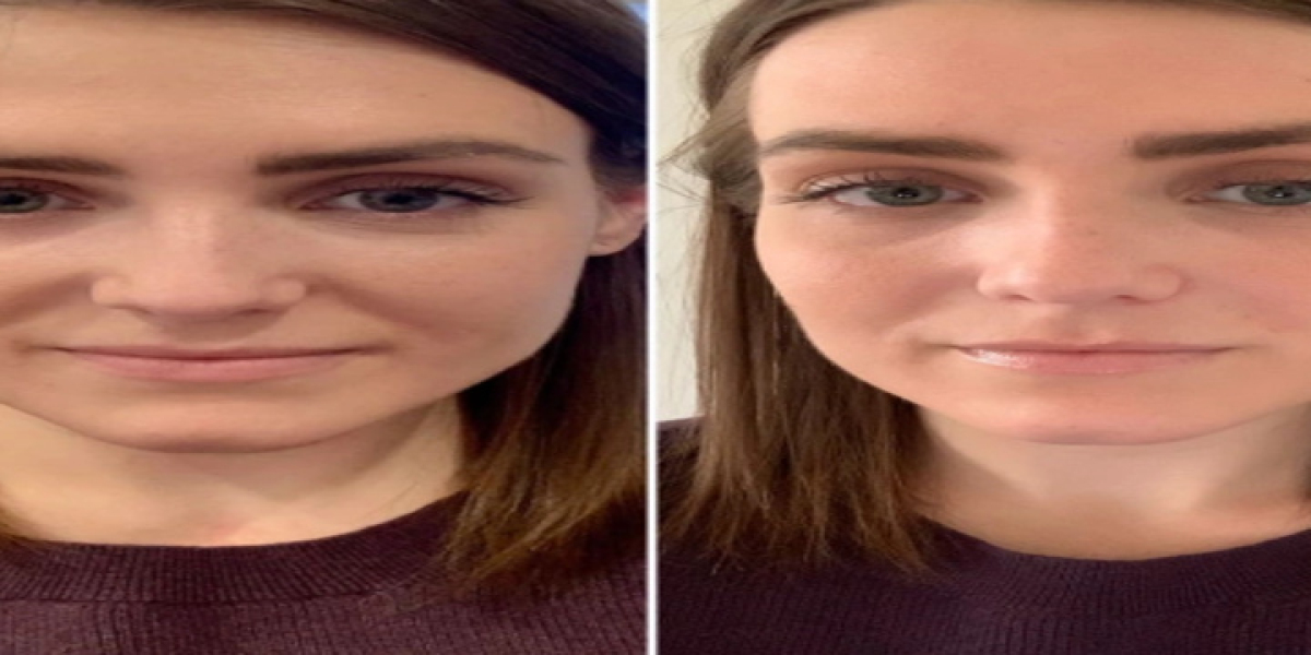 Best Aesthetic Clinic in Dubai PRP Injection Recovery