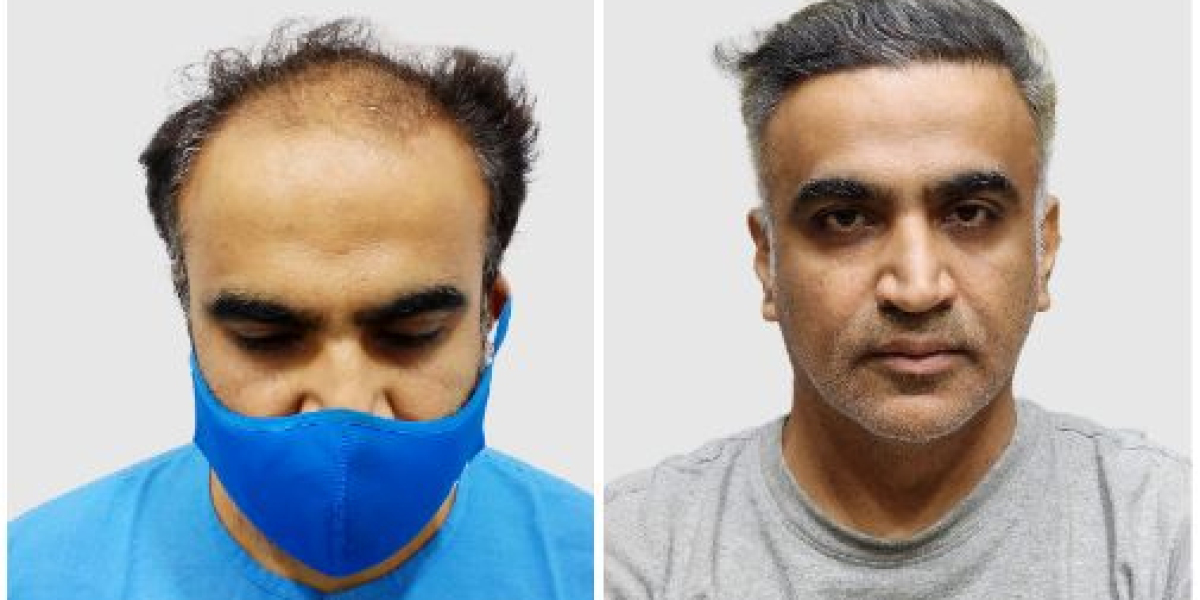 Effective Hair Loss Treatment in Delhi with Expert Care at Derma Clinix