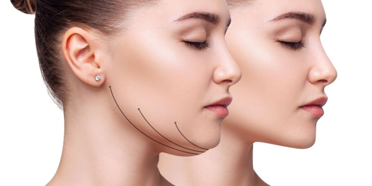 Double Chin Liposuction in Islamabad: Latest Techniques