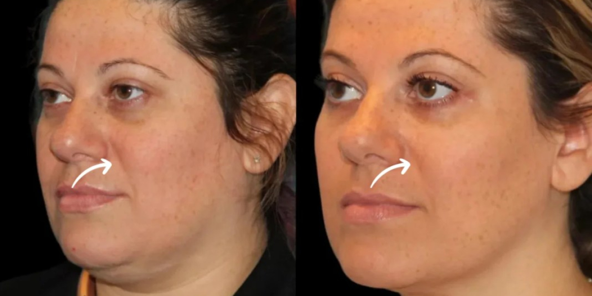 Best Aesthetic Clinics in Dubai for Sculptra Temple Enhancement