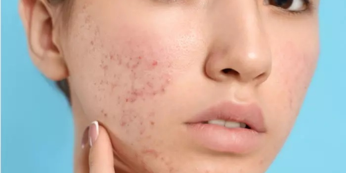 Acne Scar Treatment in Islamabad: Step-by-Step Guide