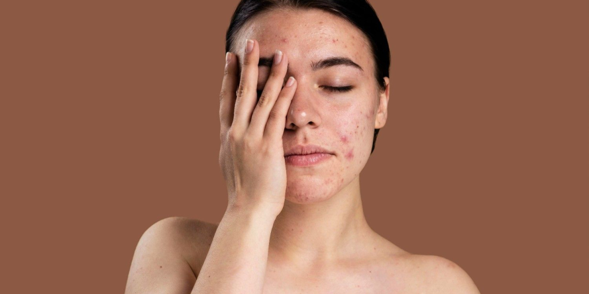 Melasma Treatment in Delhi | Pigmentation Treatment in Delhi