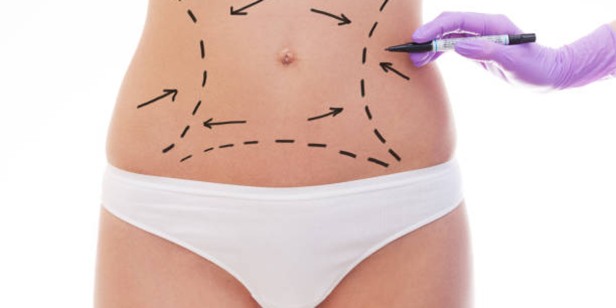 Who Is Ideal Candidate for Laser Liposuction?