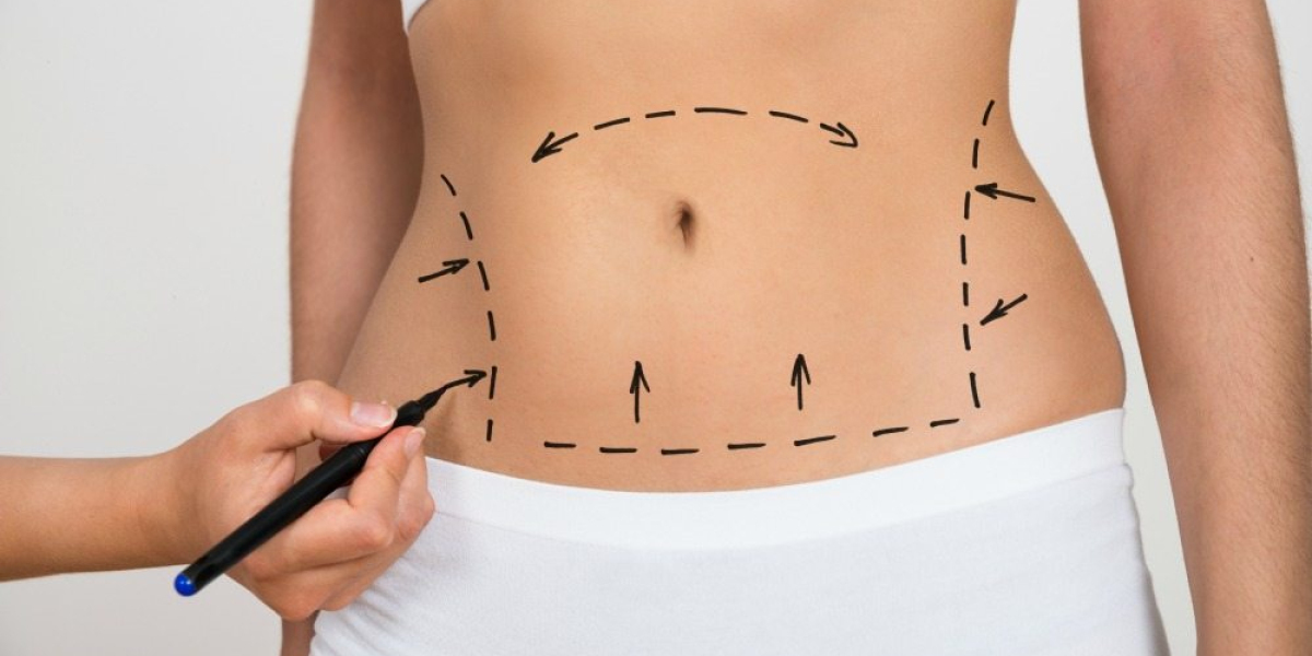 Tummy Tuck in Islamabad: Choosing the Right Surgeon