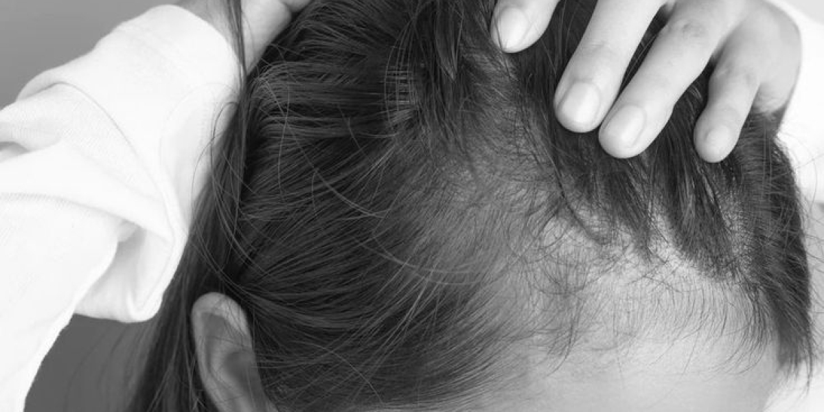 Post Treatment Care – Medlinks Hair Transplants