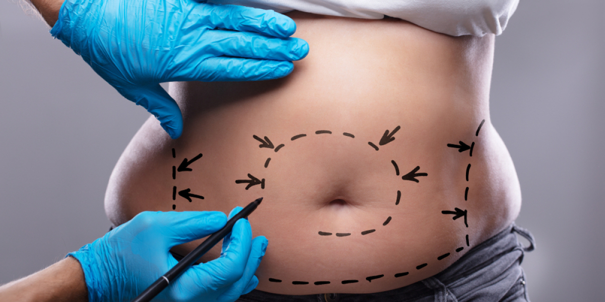 Circumferential Abdominoplasty in Islamabad: How Long Does It Take to Heal?