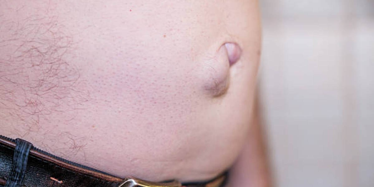 Hernia Surgery for Active Lifestyle Patients