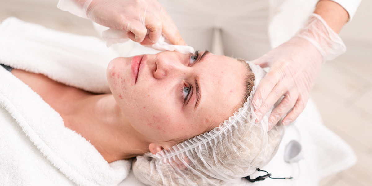 The Role of Hormones in Acne Breakouts