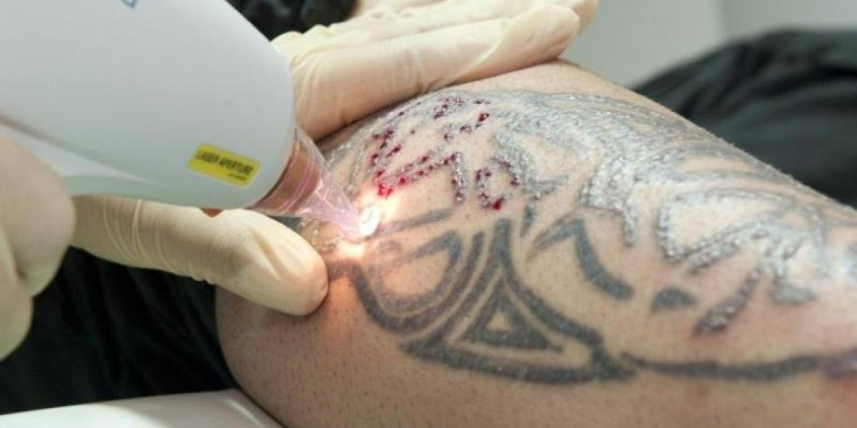 Why Is Laser Tattoo Removal Known for Delivering Safe and Impressive Results?