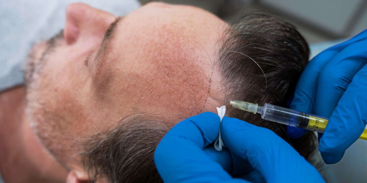 Hair Transplant Surgery in Delhi – Dr Prakash Kumar Khute | Skin Roots Clinic
